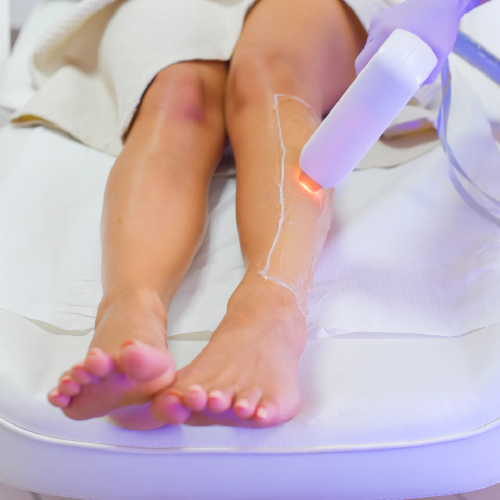 Laser treatment for permanent hair removal.