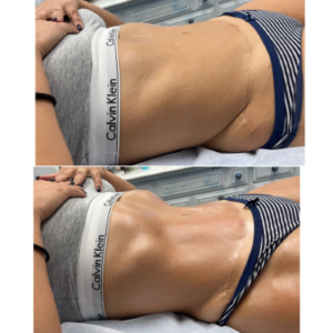 Body countoring