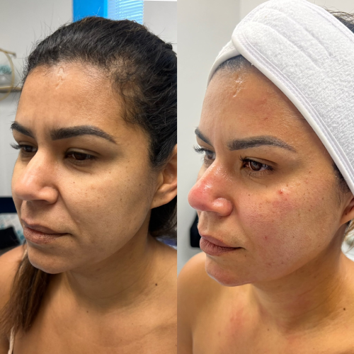 Ultraformer treatment for skin tightening and lifting