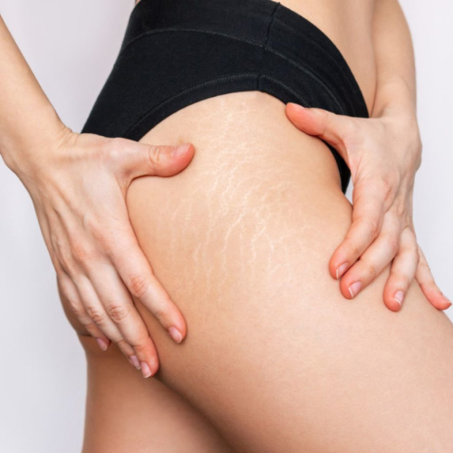 specialized stretch mark treatments