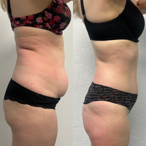 Body contouring and fat reduction treatment