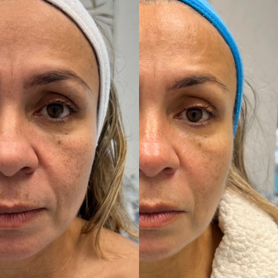 Natural results from a facial treatment using advanced High-Intensity Focused Ultrasound (HIFU) technology