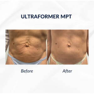 Rejuvenate Your Skin with Ultraformer HIFU at StarBella